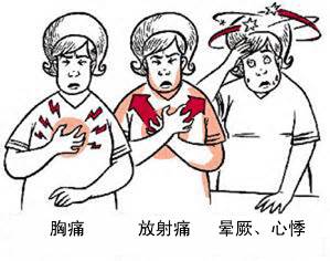冠心病有哪些癥狀？(圖1)