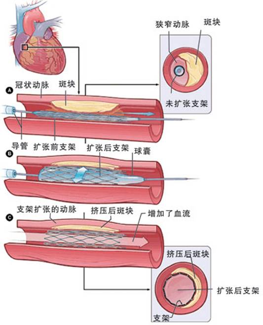 怎樣治療冠心??？(圖2)