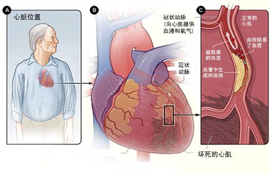 怎樣治療冠心??？(圖3)