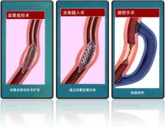 怎樣治療冠心??？