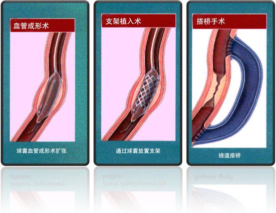 怎樣治療冠心??？(圖1)