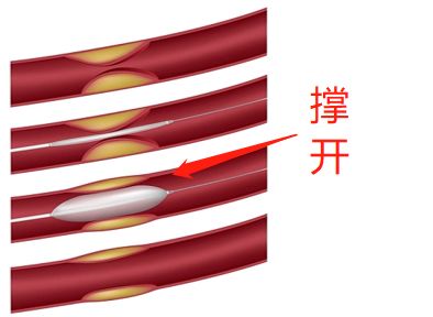 什么是藥物球囊？(圖2)
